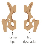 嬰幼兒發展性髖關節發育不良與預防篩檢